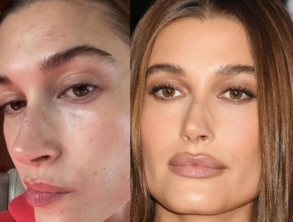 9 звезд, у которых проблемная кожа: как они за ней ухаживают