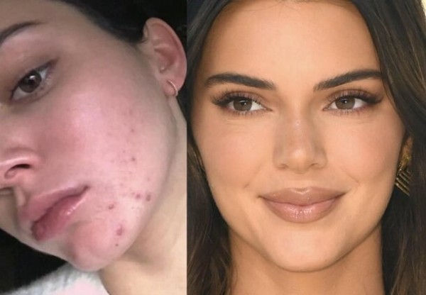 9 звезд, у которых проблемная кожа: как они за ней ухаживают