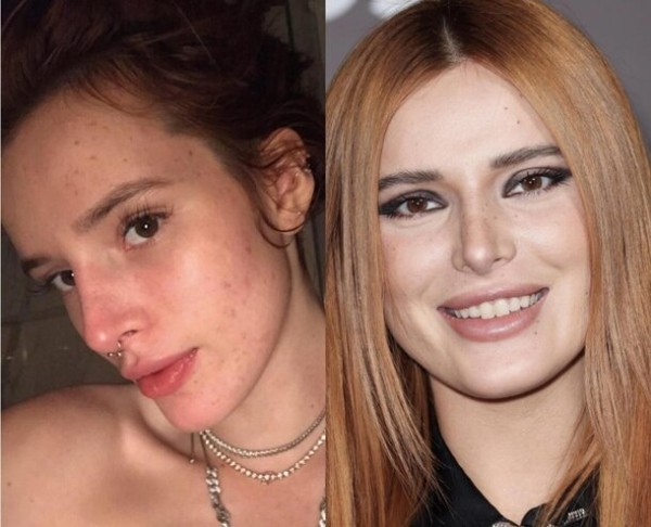 9 звезд, у которых проблемная кожа: как они за ней ухаживают